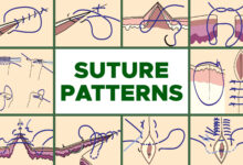 Common Suture Patterns 97 Common Suture Patterns: Interrupted, Continuous, Appositional, Inverting, Tension and Others