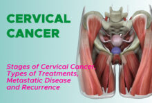 Cervical Cancer: Stages, Types of Treatments 89 Stages of Cervical Cancer, Surgery, Radiation Therapy, Chemotherapy, Targeted Therapy, Immunotherapy, Metastatic Cervical Cancer and Recurrence