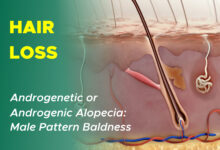 Male Pattern Hair Loss: Androgenetic Alopecia 85 Male Pattern Hair Loss: Androgenetic Alopecia Androgenic Alopecia Male Pattern Alopecia Male Pattern Baldness Pattern Baldness