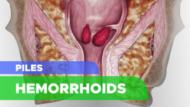 Hemorrhoids (Piles): Symptoms, Causes, Risk Factors, Prevention, Complication and Treatment 100 Hemorrhoids (Piles): Symptoms, Causes, Risk Factors, Prevention, Complication and Treatment
