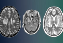 COVID-19 Survivors Literally Suffer From a Loss Gray Matter and Other Brain Tissue Over Time, a Long Term Study Suggests 86 COVID-19 Survivors Literally Suffer From a Loss Gray Matter and Other Brain Tissue Over Time, a Long Term Study Suggests