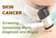 Non Melanoma Skin Cancer: Screening, Symptoms, Signs, Diagnosis and Biopsy 84 Non Melanoma Skin Cancer: Screening, Symptoms, Signs, Diagnosis and Biopsy