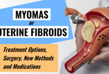 Uterine Fibroids: Treatment Options, Surgery, New Methods 76 Uterine Fibroids Myomas Treatment Options, Surgery, New Methods and Medications