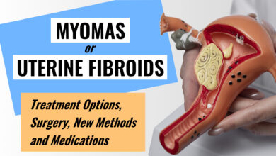 Uterine Fibroids: Treatment Options, Surgery, New Methods 114 Uterine Fibroids Myomas Treatment Options, Surgery, New Methods and Medications