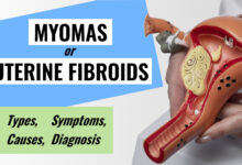 Uterine Fibroids (Myomas): Types, Causes, Symptoms, Diagnosis 77 Uterine Fibroids Myomas Causes, Types, Symptoms, Diagnosis