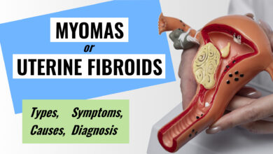 Uterine Fibroids (Myomas): Types, Causes, Symptoms, Diagnosis 116 Uterine Fibroids Myomas Causes, Types, Symptoms, Diagnosis