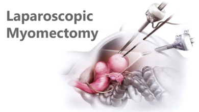 Laparoscopic Myomectomy: Is it Better? 65 Laparoscopic Myomectomy